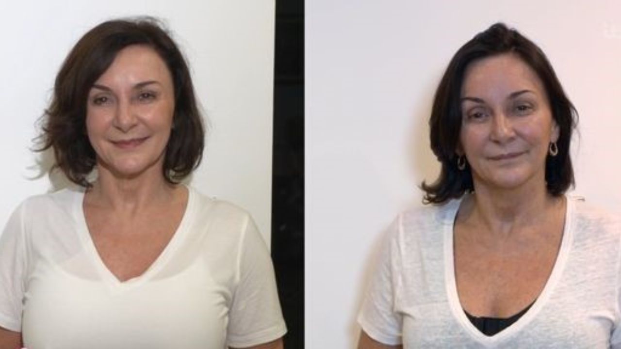 Shirley Ballas before and after breast implant removal surgery.