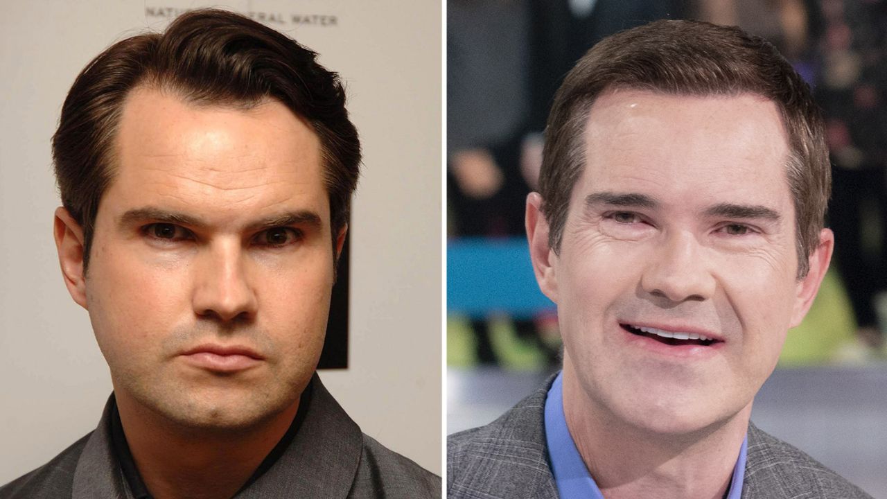 Jimmy Carr before and after cosmetic surgery. spritelybud.com